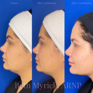 Kybella Before and After Photos from Bellora Medical Aesthetics