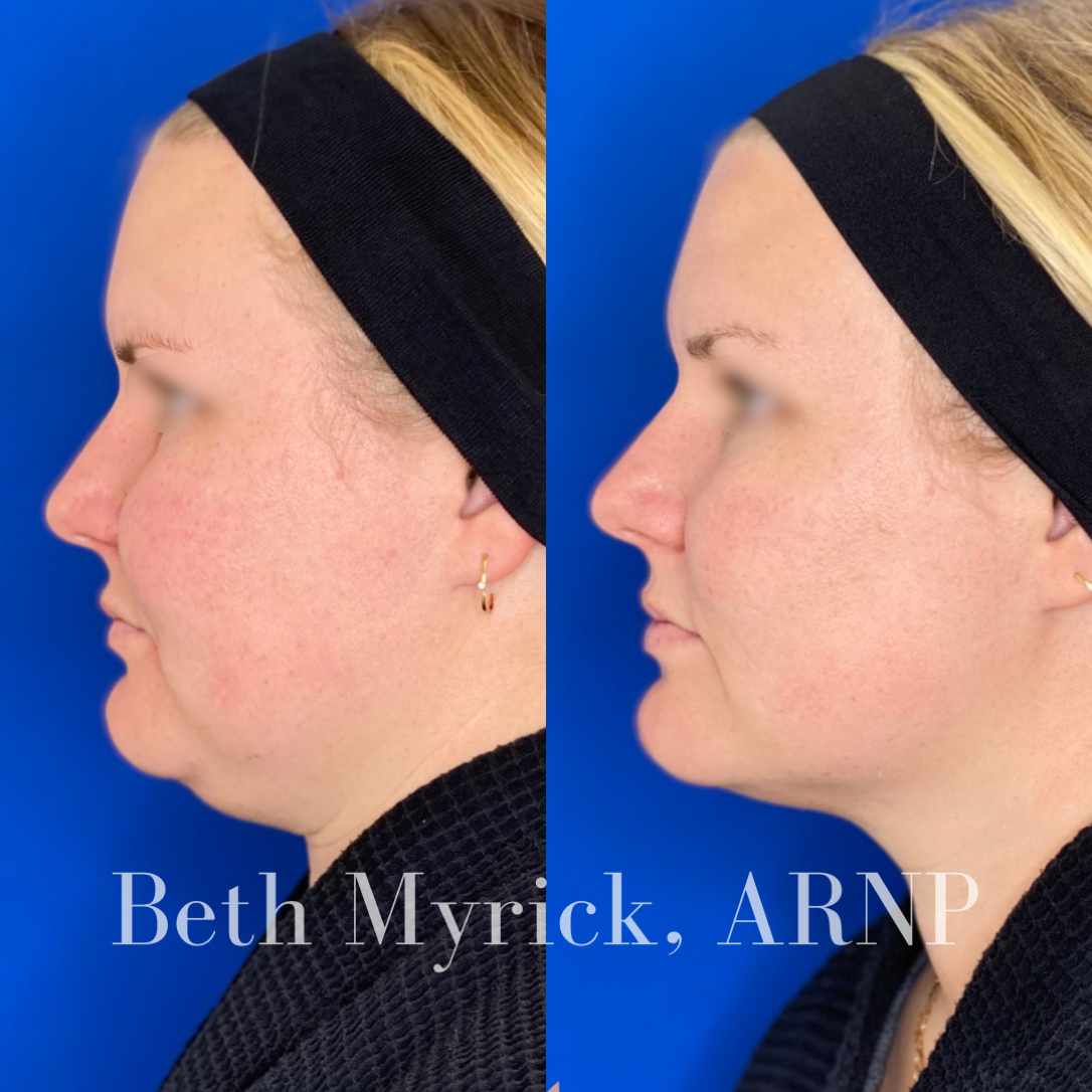Kybella Before and After: Chin Fat Reduction