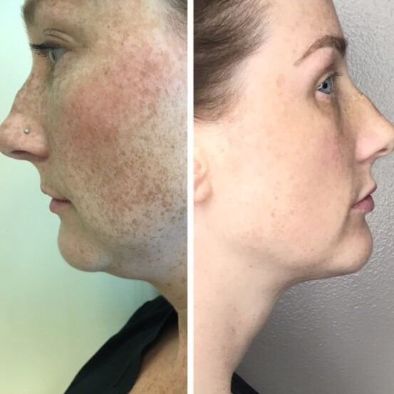 “I believe in Kybella so much, I used it on myself!” —Beth Myrick