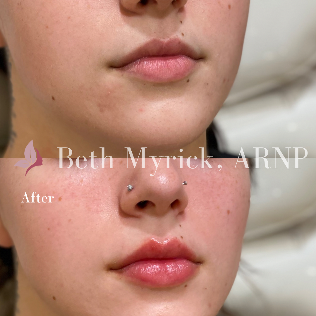Lip Filler Before and After Photo from Bellora Medical Aesthetics