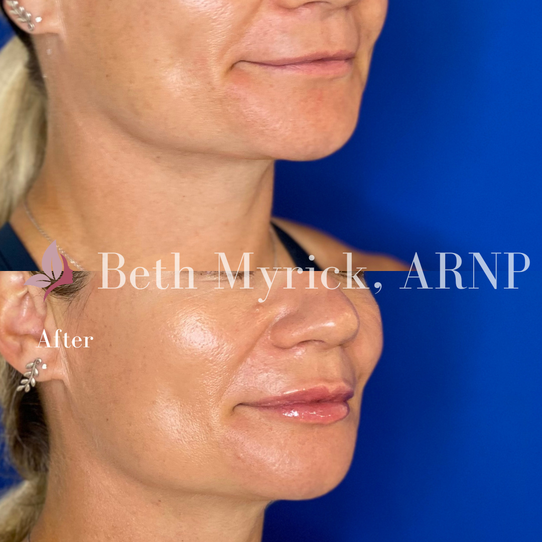 Lip Filler Before and After Photo from Bellora Medical Aesthetics