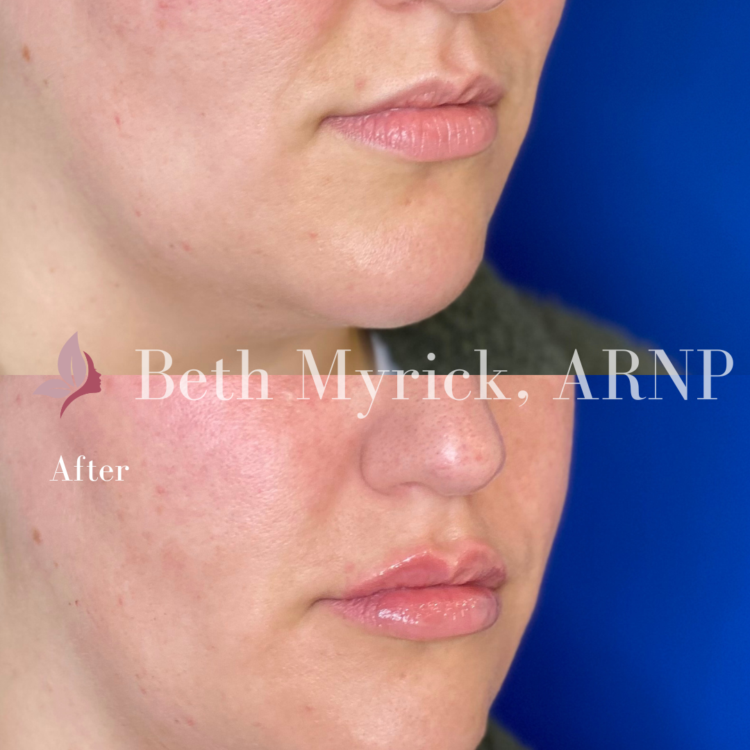 Lip Filler Before and After Photo from Bellora Medical Aesthetics