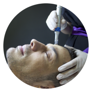 PRF and Microneedling with SkinPen by Crown Aesthetics at Bellora Medical Aesthetics in Seattle