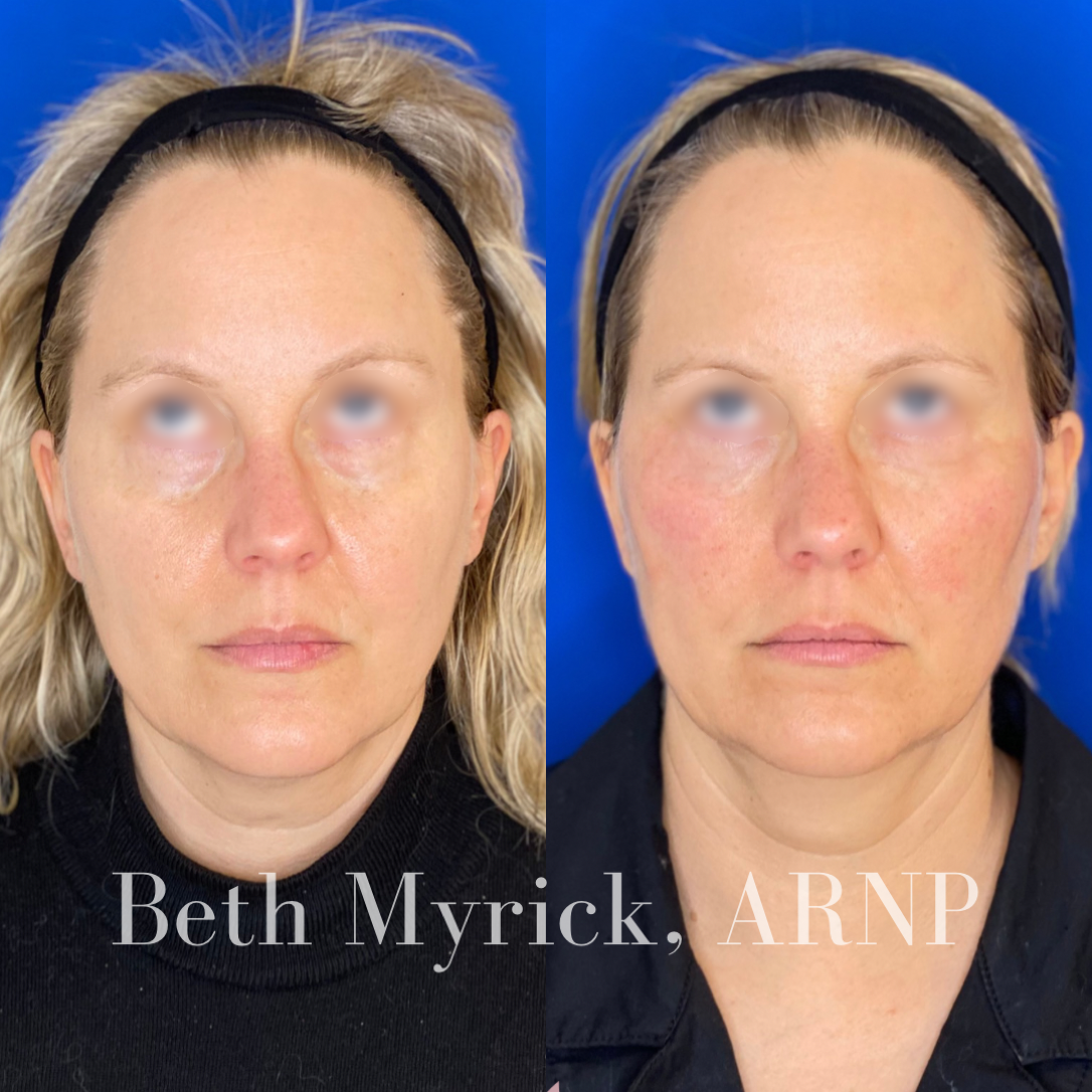 PRF Microneedling Before and After: Under Eye Injections