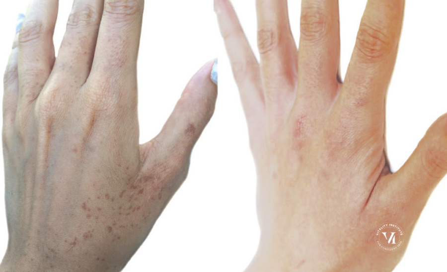 Hand transformation after a VI Peel Precision Plus treatment