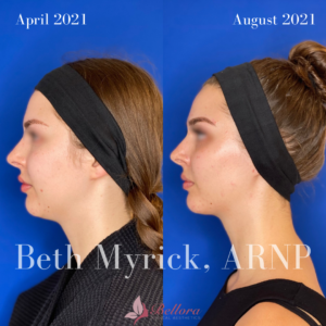 Voluma Filler at Bellora Medical Aesthetics & Spa with Beth Myrick, Seattle Injection Nurse